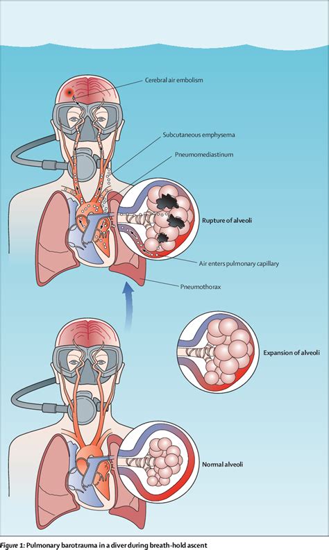 Figure 1 From Decompression Illness Semantic Scholar