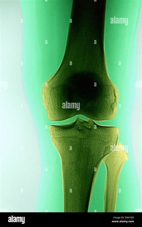 Rayos x de rodilla normal fotografías e imágenes de alta resolución - Alamy