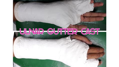 Ulnar Gutter Cast By Rakekrittanai Youtube