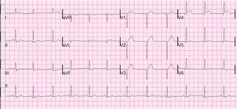 Dr. Smith's ECG Blog: Subtle LAD Occlusion with Pseudonormalization of ...