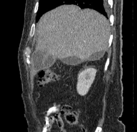 Gallbladder Perforation Image