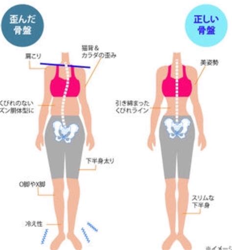 骨盤の歪み Applemintoの日記