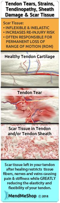 Lateral Epicondylitis Information Aka Tennis Elbow