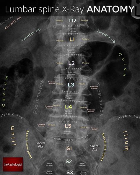 Oren Gottfried Md On Twitter Lumbar Spine Anatomy On X Ray From The