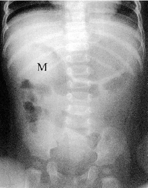 Figure 1 From Treatment Of Pediatric Intussusception By Pneumatic Reduction Under Ultrasound