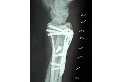 Fractura De Mu Eca O Radio Distal Tratamiento Conservador O Cirug A