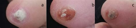 Plantar Wart Removal Stages