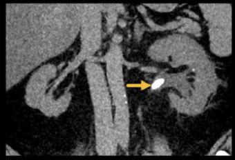 Abdominal Ct Gu Imaging Litfl Radiology Library