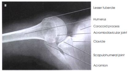 INFEROSUPERIOR AXIAL PROJECTION: SHOULDER (NONTRAUMA) - RadTechOnDuty