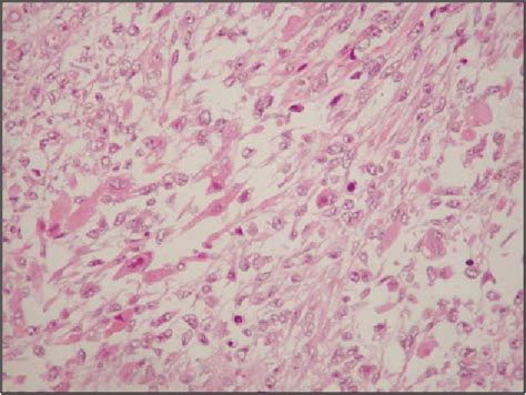 Figure 3 From A Rare Case Of Paratesticular Embryonal Rhabdomyosarcoma