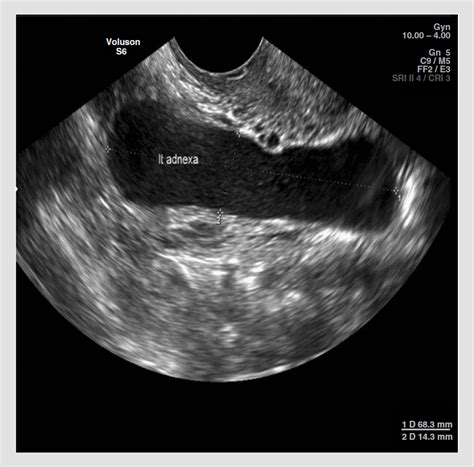 Transvaginal Ultrasongraphy Showing The Left Adnexal Tubular Cystic