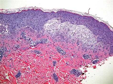 Lupus Erythematosus Histology