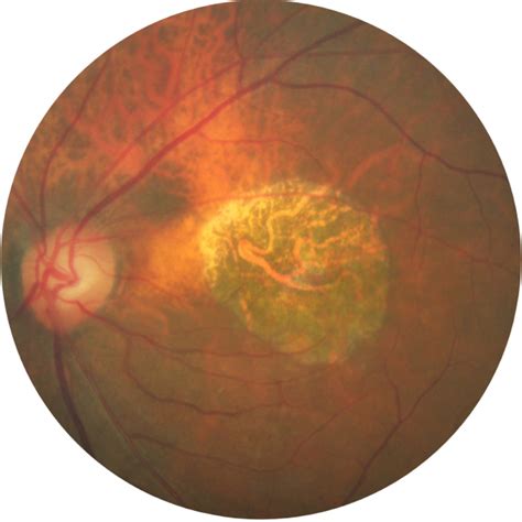 Geographic Atrophy Disease Progression Diagnosis Apellis