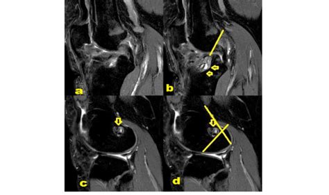 A Years Old Patient With Completely Disrupted Acl Graft And