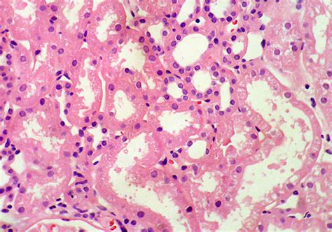 Proteinuria - Glucosuria