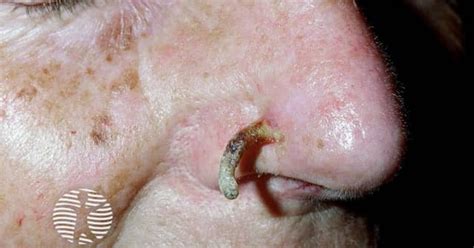 Cutaneous horn image