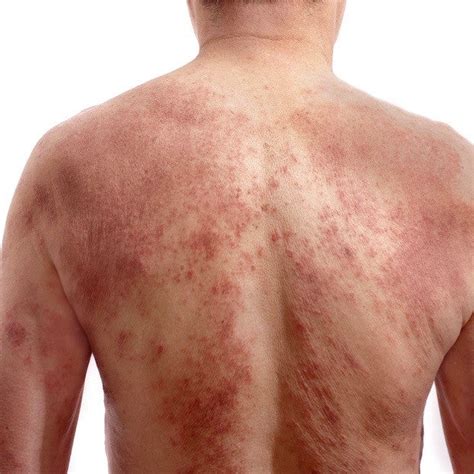 What is red skin syndrome? – Eczema Life