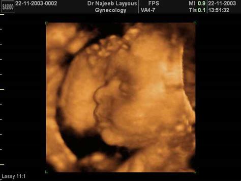 3d Fetal Profile Ultrasound Scan Photos Dr N Layyous