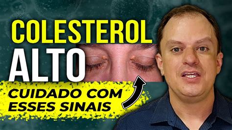 COLESTEROL ALTO CAUSAS E SINTOMAS YouTube