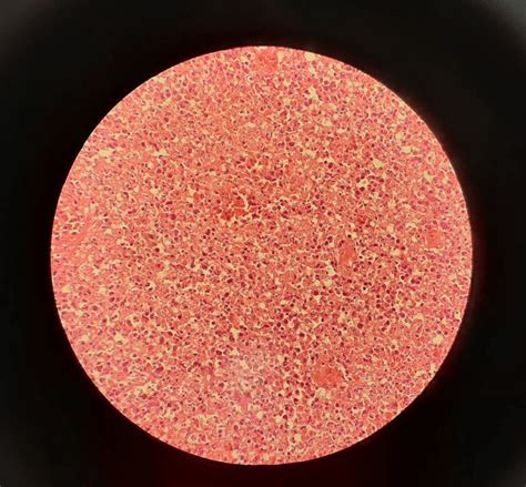 A Core Needle Biopsy Was Performed From A Cervical Lymph Node And Download Scientific Diagram