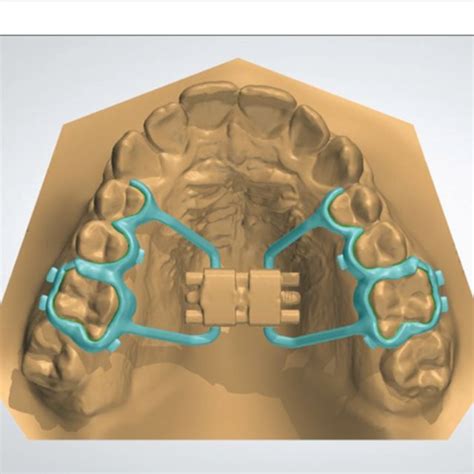 Passive Lingual Arch In Situ Download Scientific Diagram