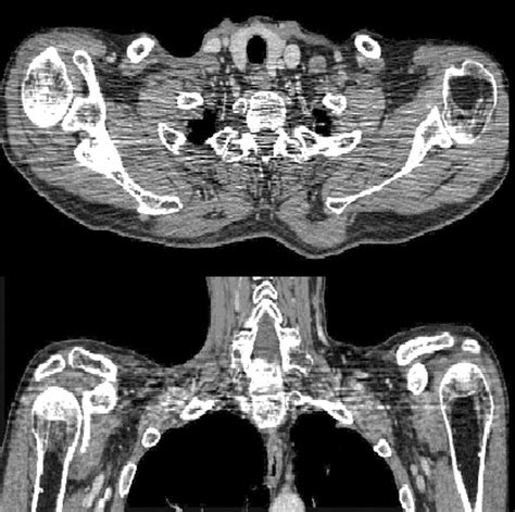 Artifacts In Ct Recognition And Avoidance Radiographics