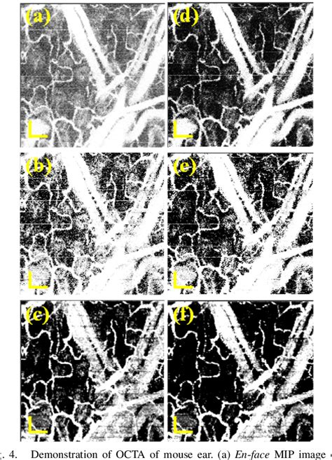 Figure From High Contrast Optical Coherence Tomography Angiography