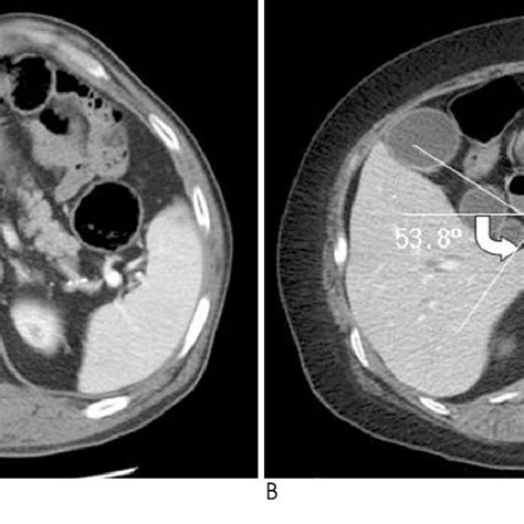 Photograph of Hartmann's pouch of the gallbladder. Gb-gallbladder ...