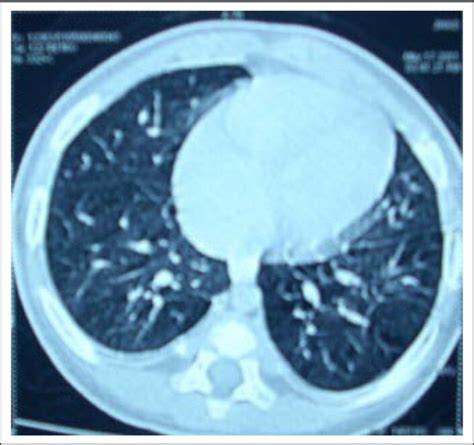 Follow-up HRCT (almost normal chest in HRCT, except mild bilateral... | Download Scientific Diagram