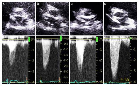 Serial echocardiograms of aortic valve short-axis view at maximal ...