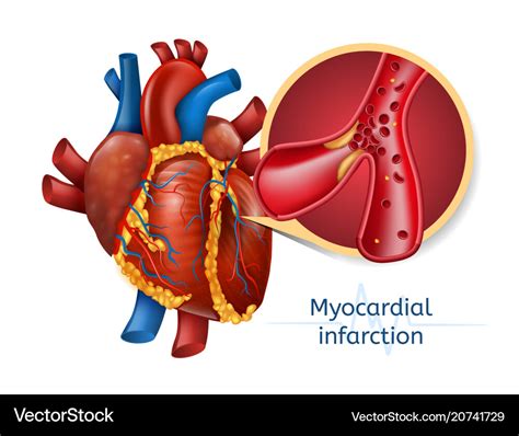 Myocardial Infarction 3d Realostic Heart Vector Image