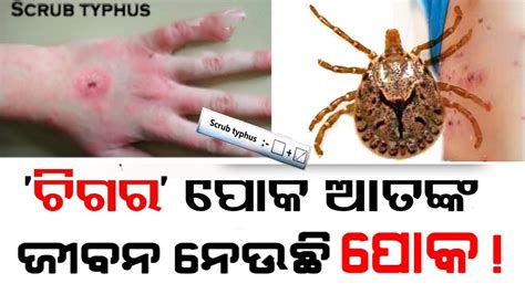 Outrage Of Scrub Typhus Disease In Odisha L Diagnosis Symptoms And