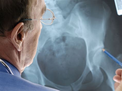 Hip Replacement Surgery: Things to Consider