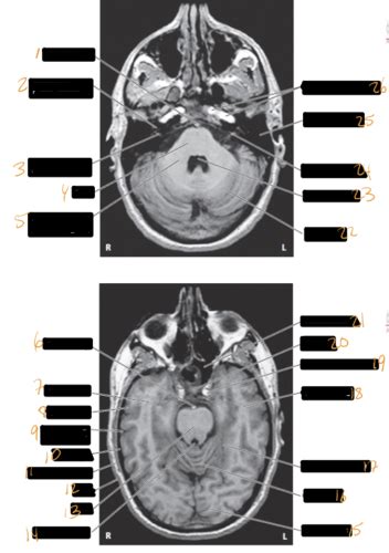 Lab Mri Lab Mri Lab Mri Lab Mri Flashcards Quizlet