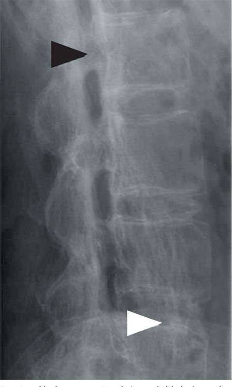 Figure 1 from Bamboo spine – X-ray findings of ankylosing spondylitis ...