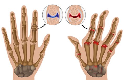 Artrite E Artrose Entenda A Diferen A E Os Tipos De Tratamento