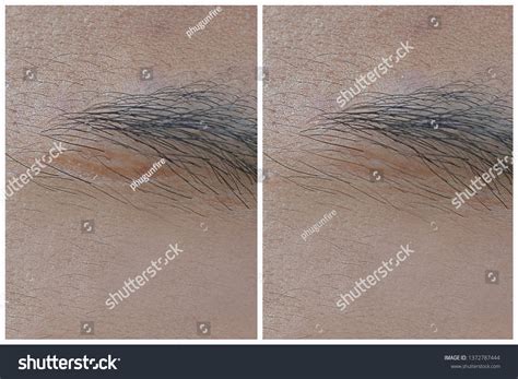 Before After Scar Treatment Stock Photo 1372787444 | Shutterstock