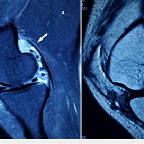 Mri Of Left Knee Shows Diffuse Nodular Synovial Hypertrophy In T2w A