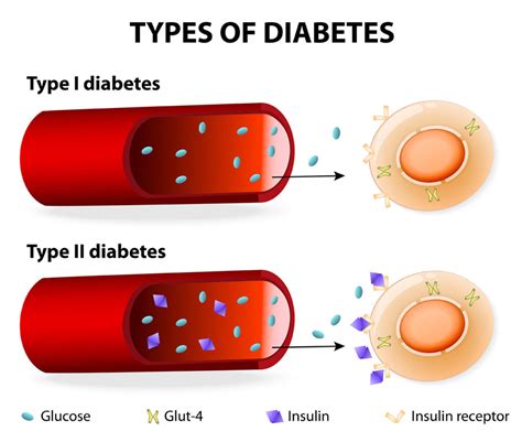 Diabetes Mellitus Type 1 Pathogenesis Of Type 1 Diabetes Mellitus