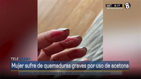 Mujer Sufre De Quemaduras Graves Por Uso De Acetona Telediario Costa Rica