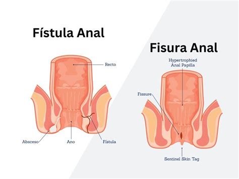 Understanding The Differences Between Anal Fistula And Anal Fissure Everything You Need To Know