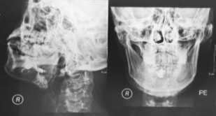 Sialograph, blue arrow show sialolithiasis | Download Scientific Diagram