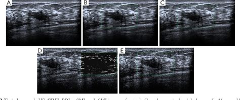 Figure 1 From Superb Microvascular Imaging For Evaluation Of