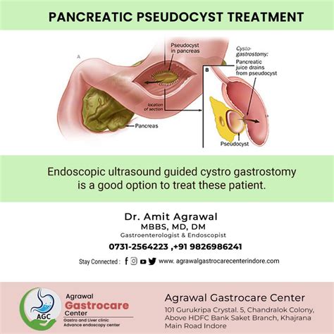 Pancreatic Pseudocyst Treatment Causes Symptoms