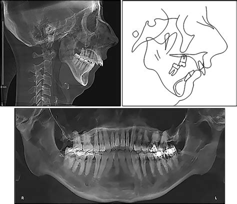 Pretreatment Lateral Cephalogram Tracing And Panoramic Radiograph