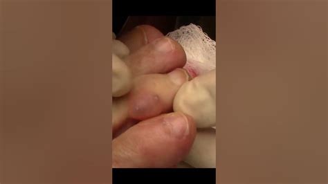 Digital Myxoid Cyst Shorts Youtube