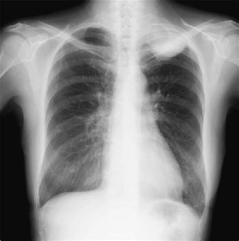 Figure From A Resected Case Of Localized Malignant Pleural