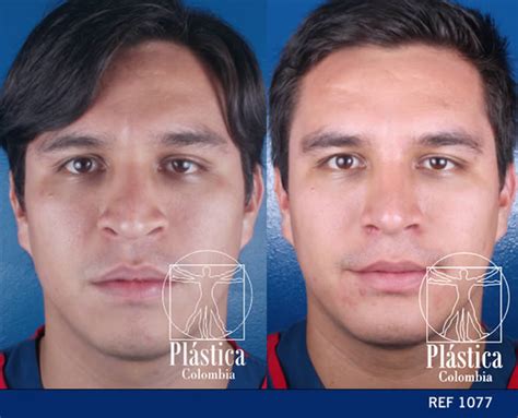 Mentoplastia Casos Hombre Plastica Colombia