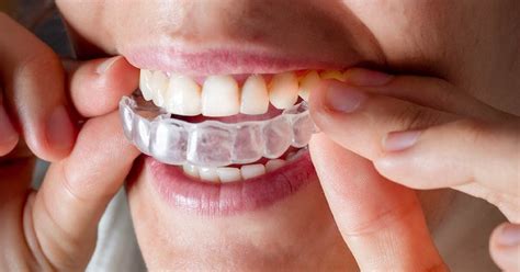 Reasons To Consider The Invisalign Treatment Reteteinimagini