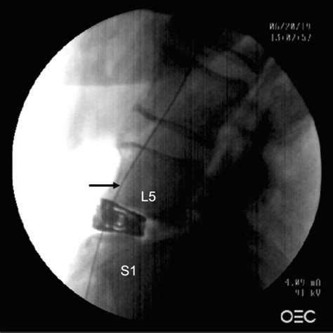 Lateral Fluoroscopy Showing The Metal Wire Arrow Attached To The Download Scientific Diagram